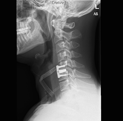 X-ray of neck with metal plate and pins.